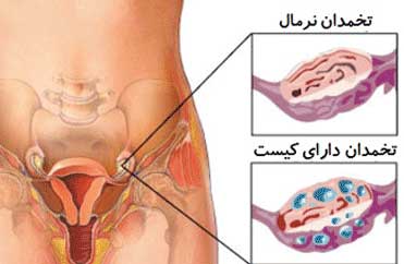 تاثیر کیست تخمدان در بارداری